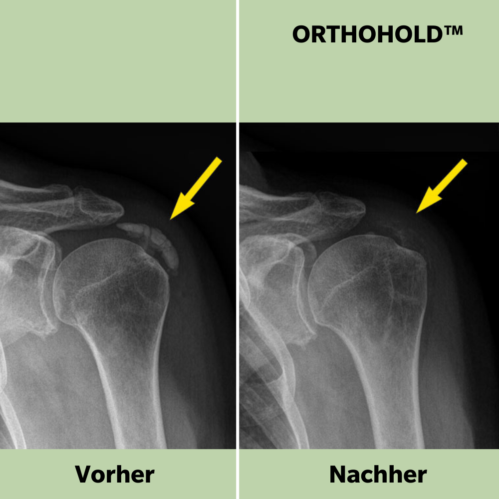 ORTHOHOLD™ - Schnelle, natürliche Linderung von Schulterschmerzen